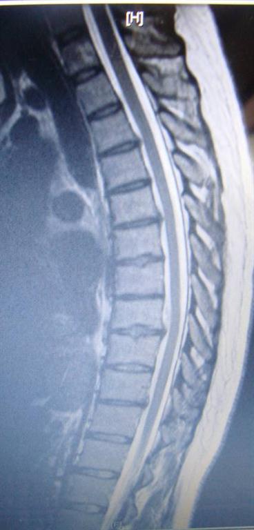 thoracic disc herniation treated by Groton chiropractor